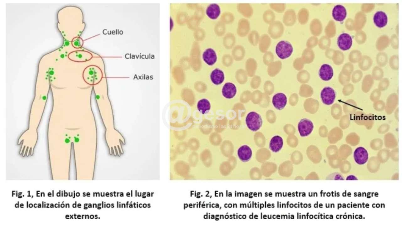 En el marco del Día Mundial de la Leucemia Linfocítica Crónica (LLC), que se conmemora cada 1º de setiembre, hematólogos destacan la importancia del diagnóstico oportuno, el seguimiento especializado y el acceso equitativo a tratamientos innovadores para las personas que conviven con este cáncer de la sangre.